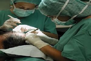 Goedkope haartransplantatie van de beste klinieken?