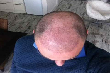 Goedkope haartransplantatie bij de beste klinieken?