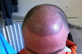 Goedkope haartransplantatie bij de beste klinieken?