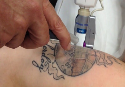 Laat uw tattoo weglaseren door de specialist van Nederland!
