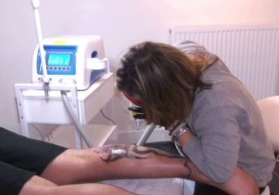 Laat uw tattoo verwijderen door een specialist!