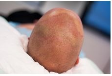 Haartransplantatie aanbieding.