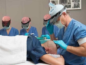 Haartransplantatie aanbieding