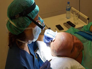 Haartransplantatie aanbieding