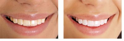 NU 2 setjes Whitelight zeer voordelig voor maar 44,95 euro!