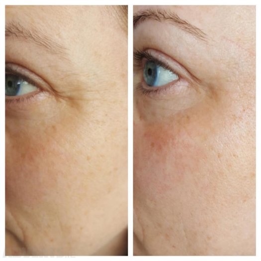 Rimpeltjes en fijne lijntjes verdwijnen voor de zon