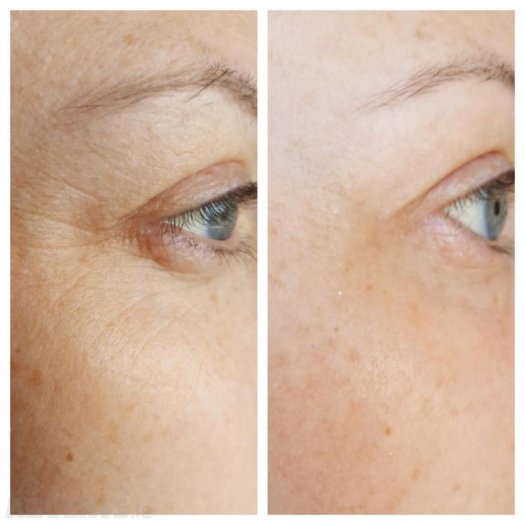 Rimpeltjes en fijne lijntjes verdwijnen voor de zon