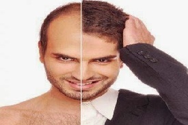 Haarimplantatie aanbieding van de beste klinieken