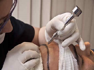 Haartransplantatie aanbieding