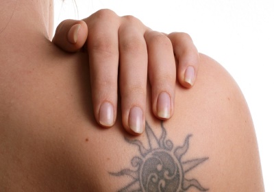 Laat uw tattoo weglaseren door de specialist van Nederland!