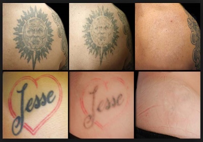 Tattoo weg laten halen door de specialist van Nederland!