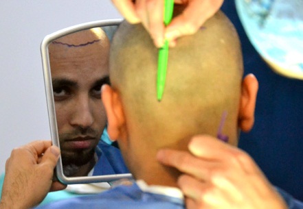 Haaruitval bestrijden met een voordelige haarimplantatie?